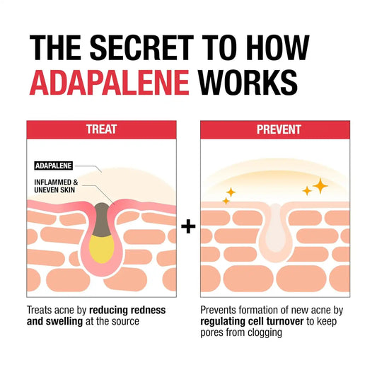 Neutrogena Adapalene Gel 0.1% Acne Treatment, 1.6 oz