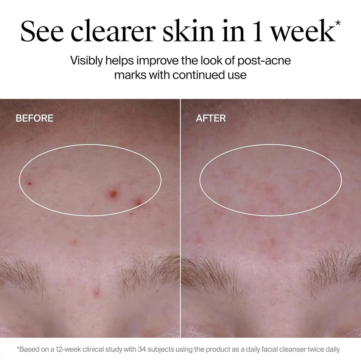 Neutrogena Evenly Clear Acne Cleanser, 9.1 fl. oz