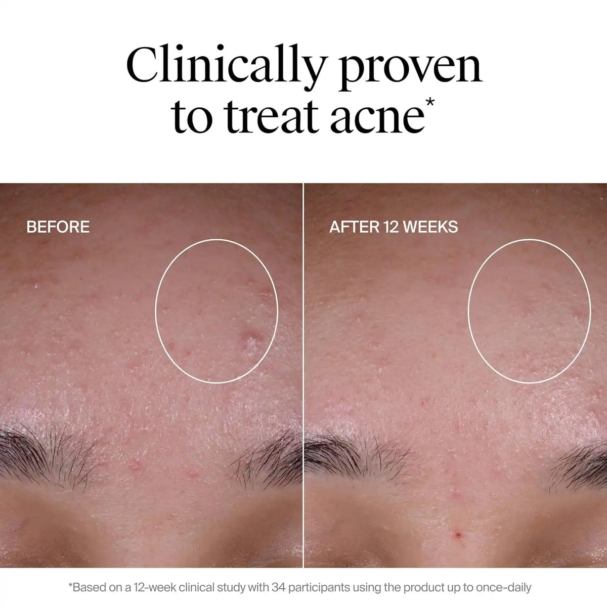 Neutrogena Evenly Clear Acne Exfoliant, 1 fl. oz